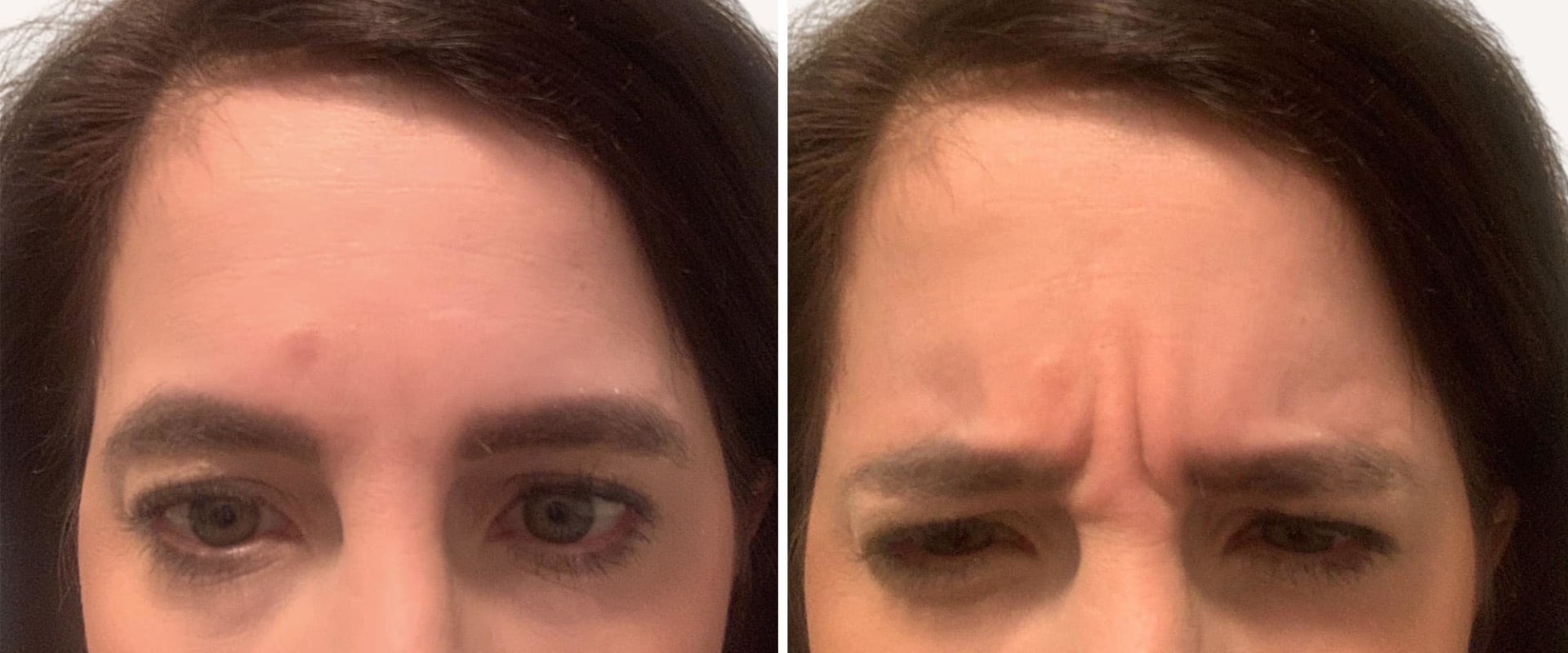 How many units of dysport or botox do you need for your forehead?