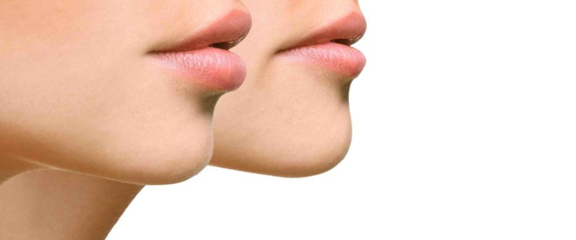 Which injectable is best for lip flip: botox or dysport