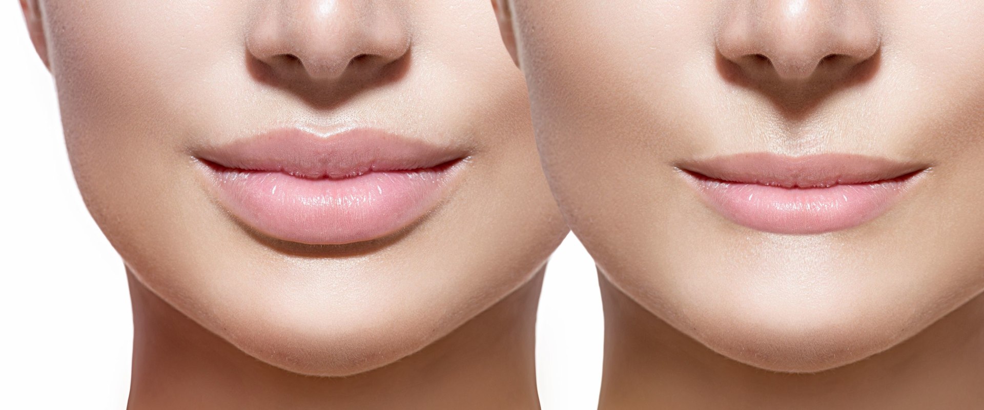 Can dysport enhance your lips?