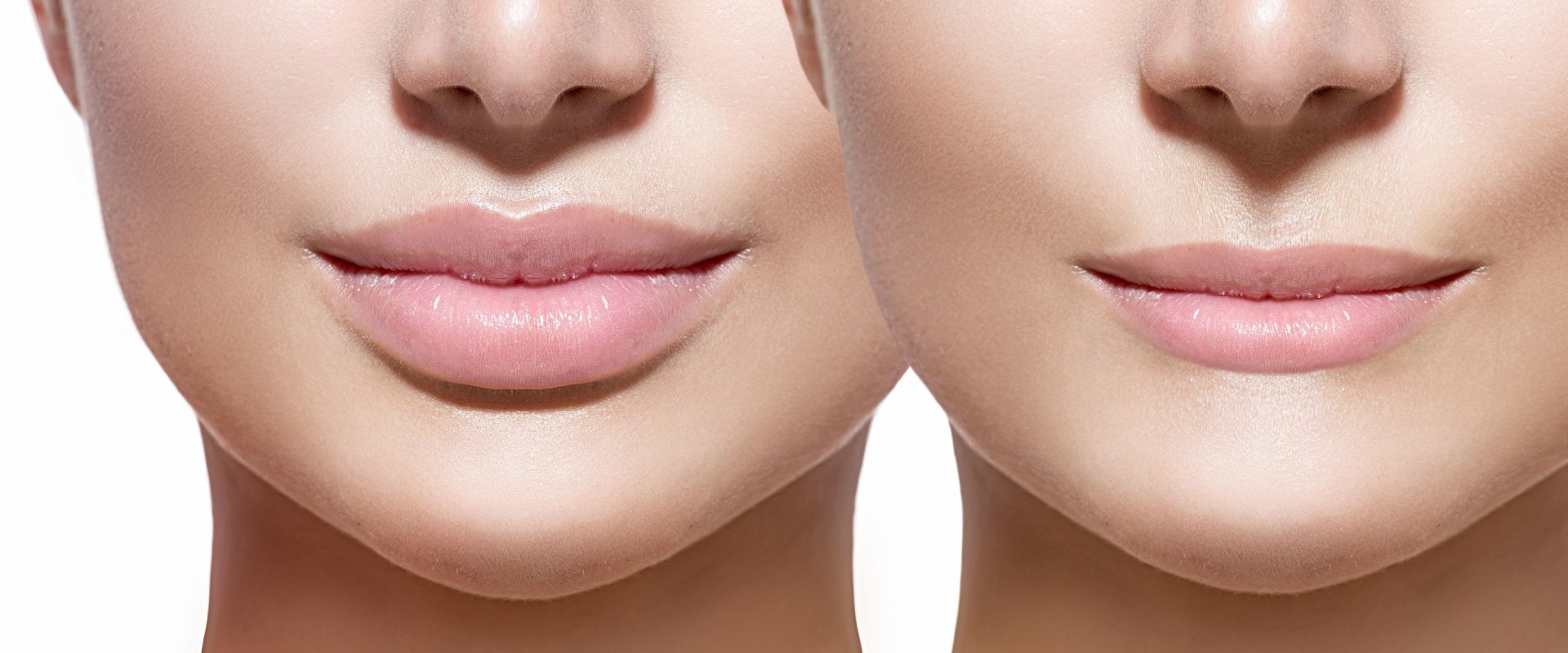 Can Dysport Enhance Your Lips?