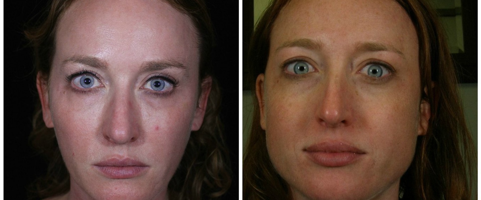 How long does dysport last in the face?