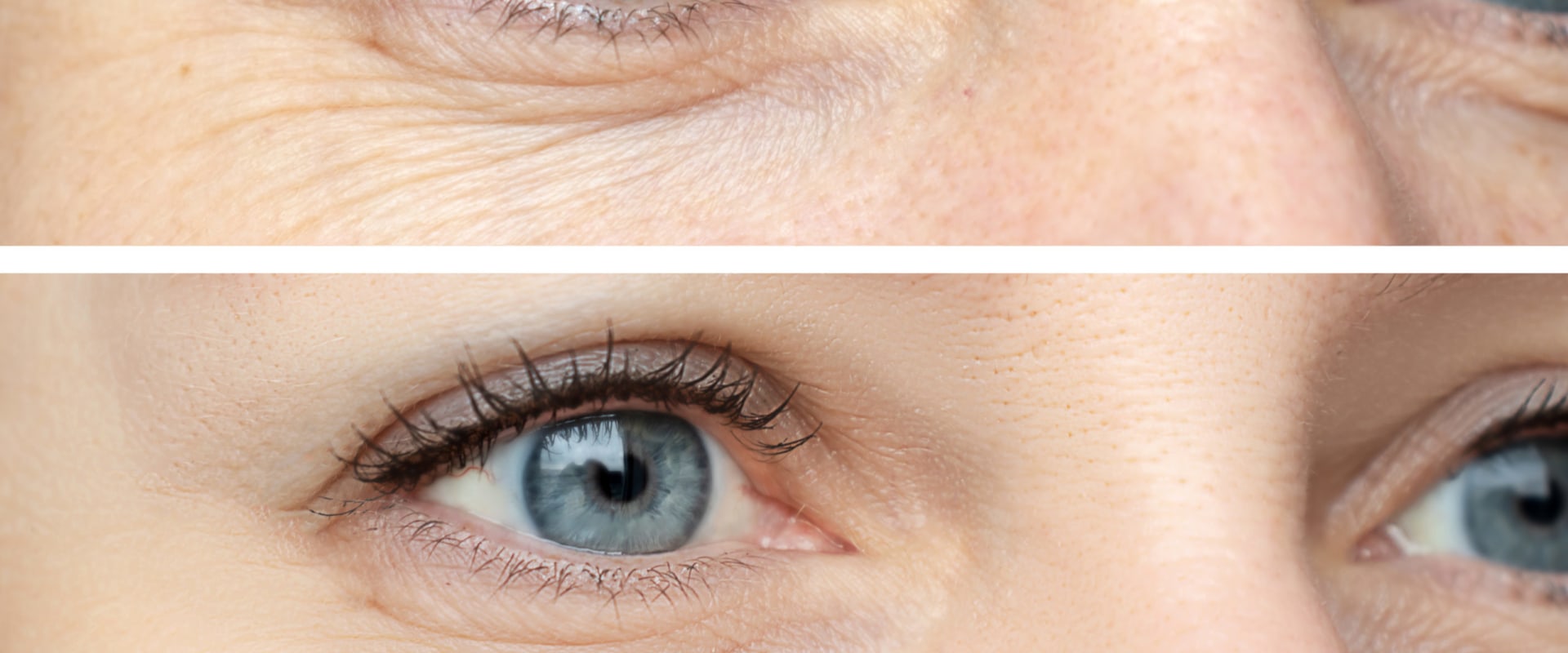 How dysport injections work to reduce wrinkles