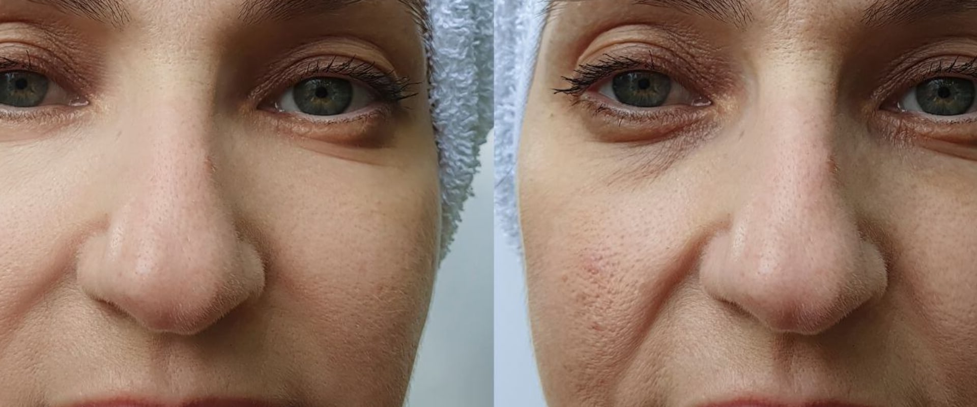 Botox vs dysport: which is cheaper and more effective?