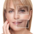 Smoothing out frown lines with dysport