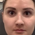 Does dysport change your face? a comprehensive guide
