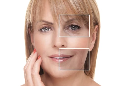 Why Choose Dysport Over Botox: An Expert's Perspective