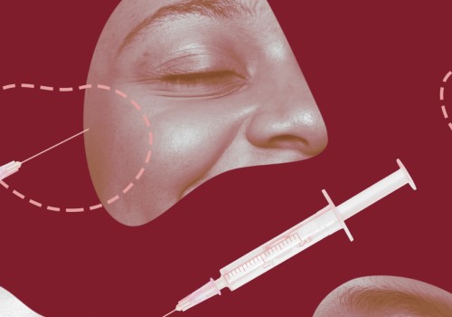 Can You Get Dysport Touch-Ups?