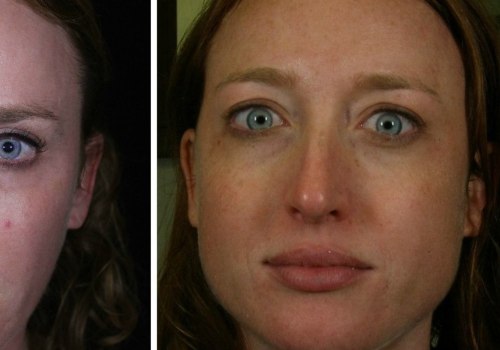 What Does Dysport Do to Enhance Your Facial Appearance?