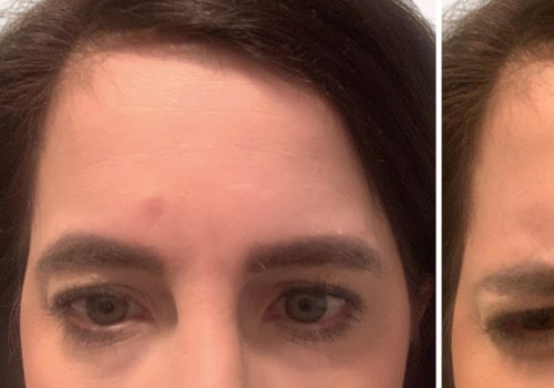 How Many Units of Dysport or Botox Do You Need for Your Forehead?