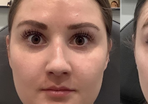 Does Dysport Change Your Face? A Comprehensive Guide