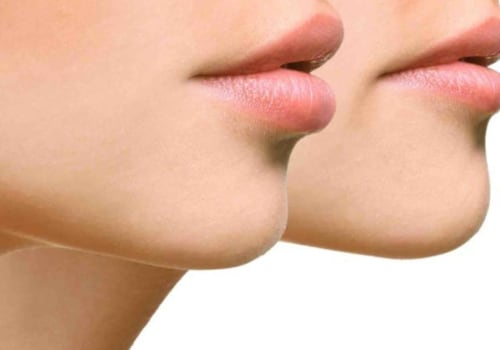 Which injectable is best for lip flip: botox or dysport