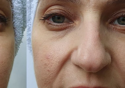 Does Dysport Last Longer Than Botox?