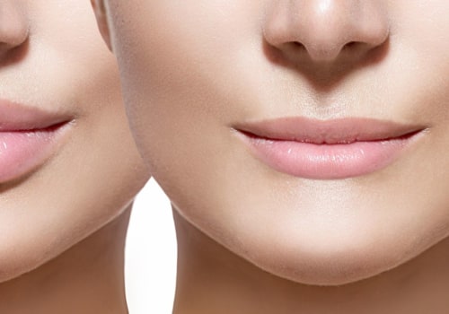 Can Dysport Enhance Your Lips?