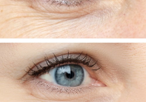 Which Injectable is Better for Glabella: Botox or Dysport?