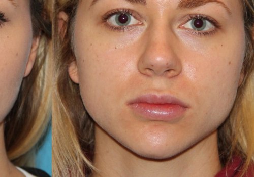 How Long Does Dysport Last Around the Mouth?